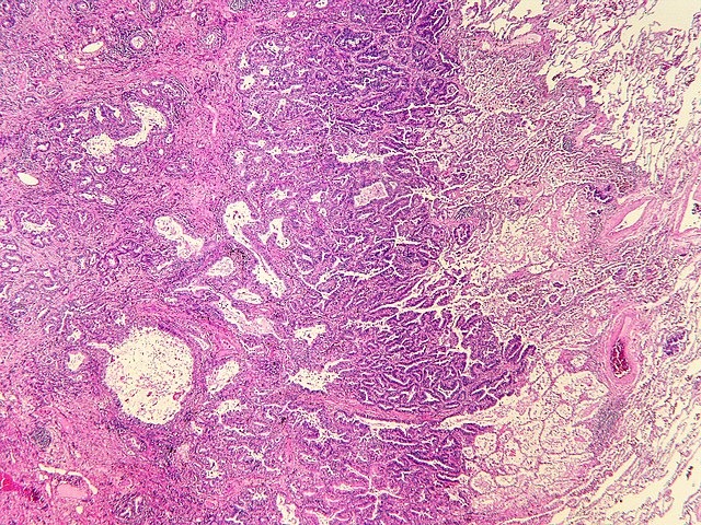 adenocarcinoma